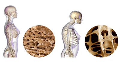 راههای پیشگیری از پوکی استخوان، پیشگیری از پوکی استخوان با مواد غذایی پوکی استخوان و تغذیه, ورزش برای پوکی استخوان