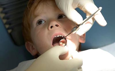 پوسیدگی دندان در کودکان,پوسیدگی دندان,عامل پوسیدگی دندان در کودکان