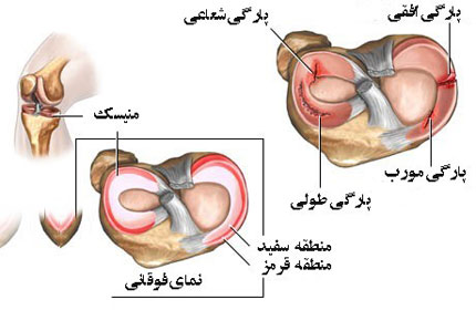 پارگی مینیسک زانو, درمان پارگی مینیسک زانو, علل پارگی پارگی مینیسک