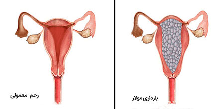 بارداری پوچ,نشانه های بارداری پوچ,درمان بارداری پوچ