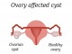 انواع کیست تخمدان و روش های درمان آن
